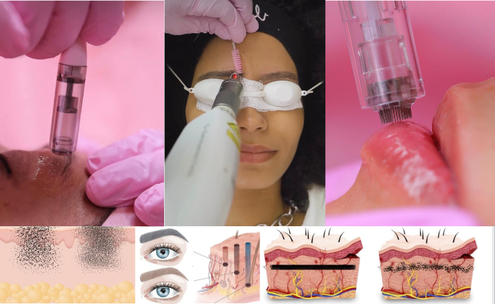 REMOCIÓN DE MICROPIGMENTACIÓN Y TATUAJES